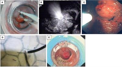 Therapeutic Upper Gastrointestinal Endoscopy in Pediatric Gastroenterology